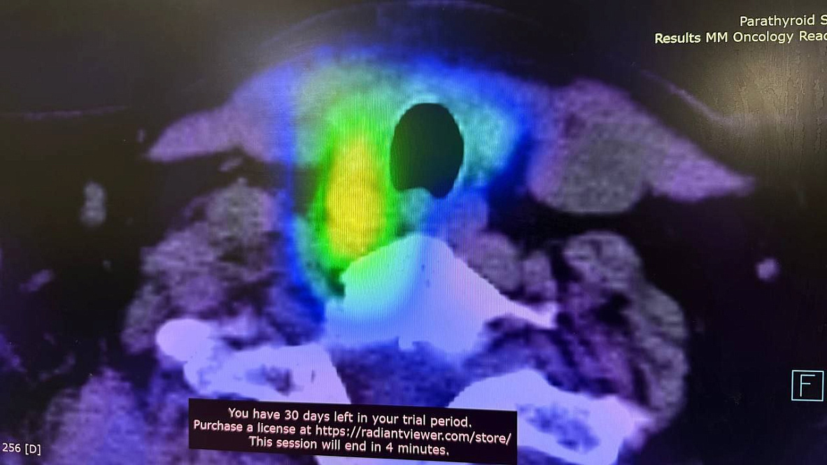 удаление паращитовидных желез операция. удаление паращитовидных желез операция. удаление паращитовидных желез операция. регуляция паращитовидной железы. удаление паращитовидных желез операция.